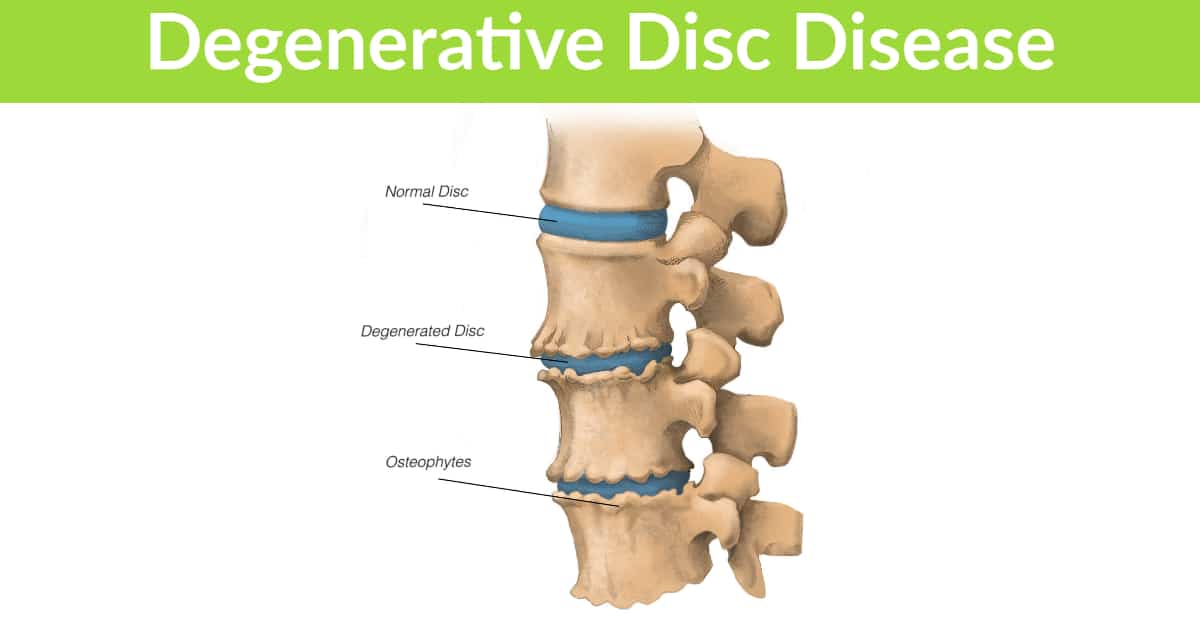 Degenerative Disc Disease