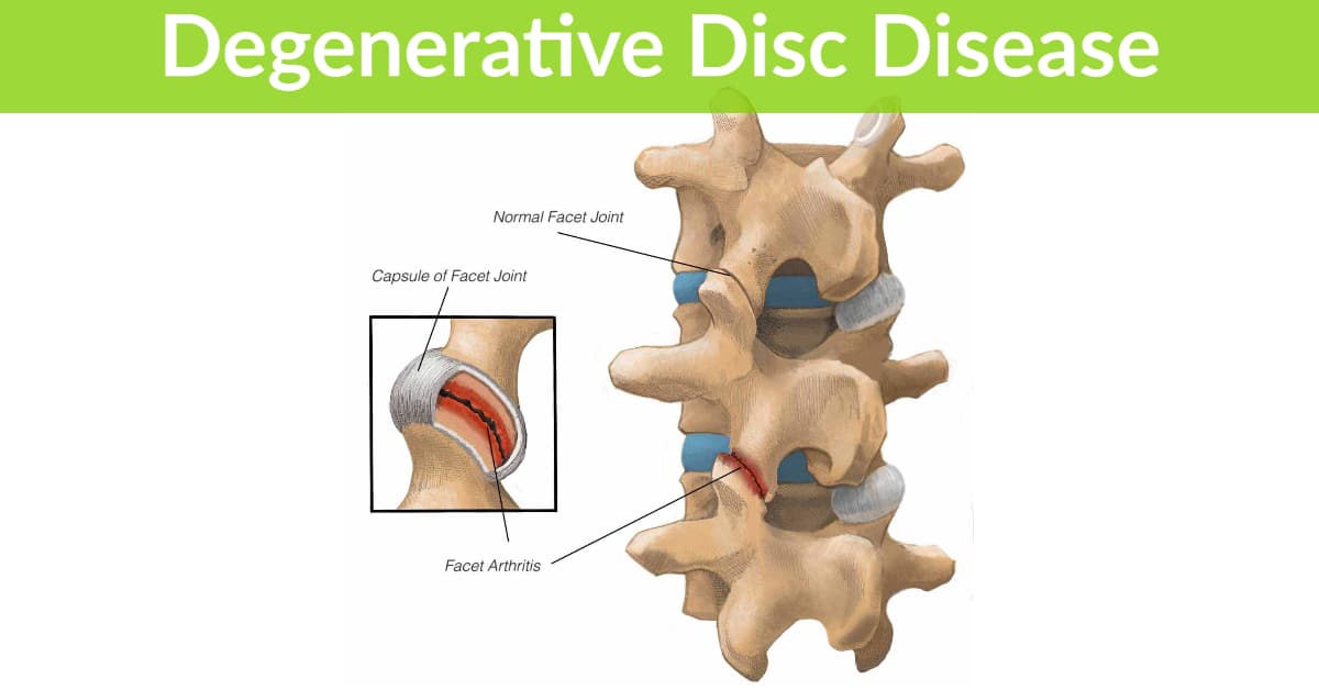 Facet Joint Syndrome