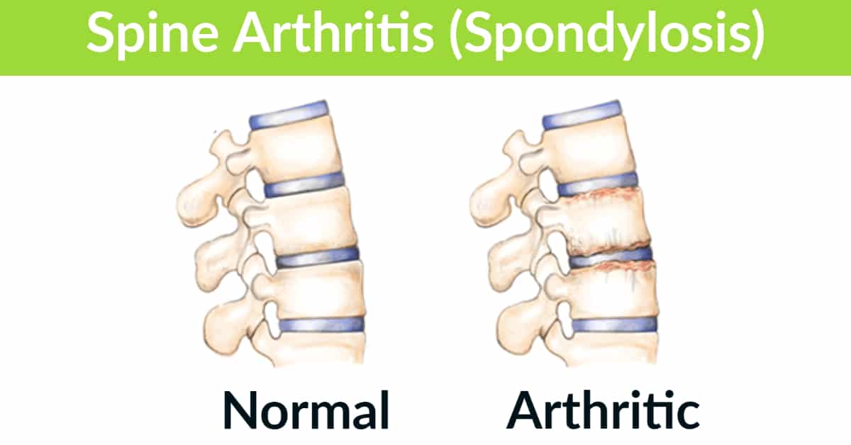 Spine Arthritis Spondylosis