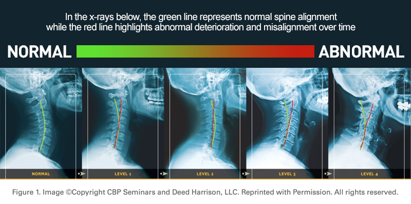 Chiropractic biophysics neck curve over time