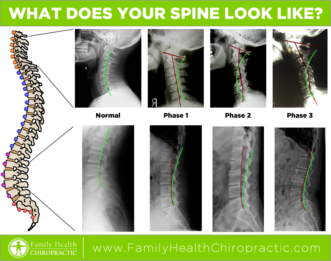 Stages of spine degeneration