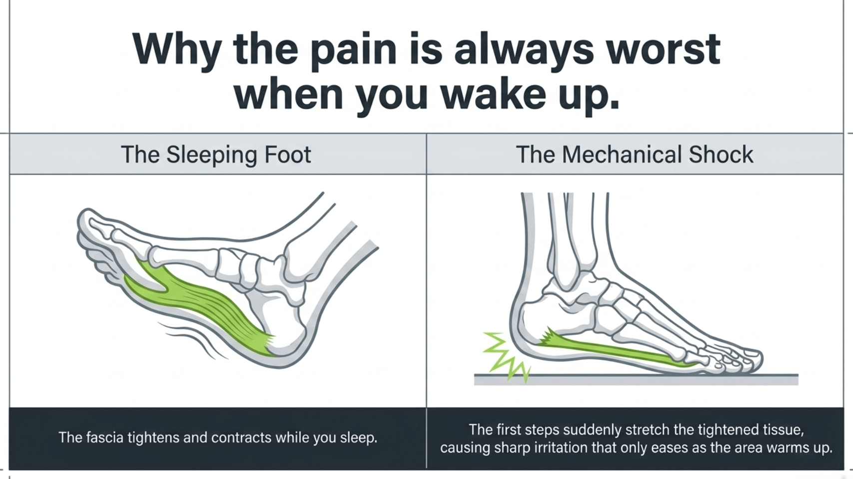 Why plantar fasciitis pain is worst in the morning: the sleeping foot tightens and contracts the fascia overnight, then the first steps stretch the tightened tissue causing sharp irritation