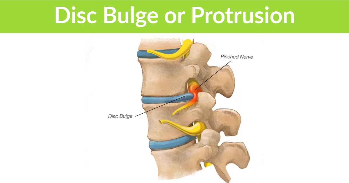 Disc Bulge or Protrusion
