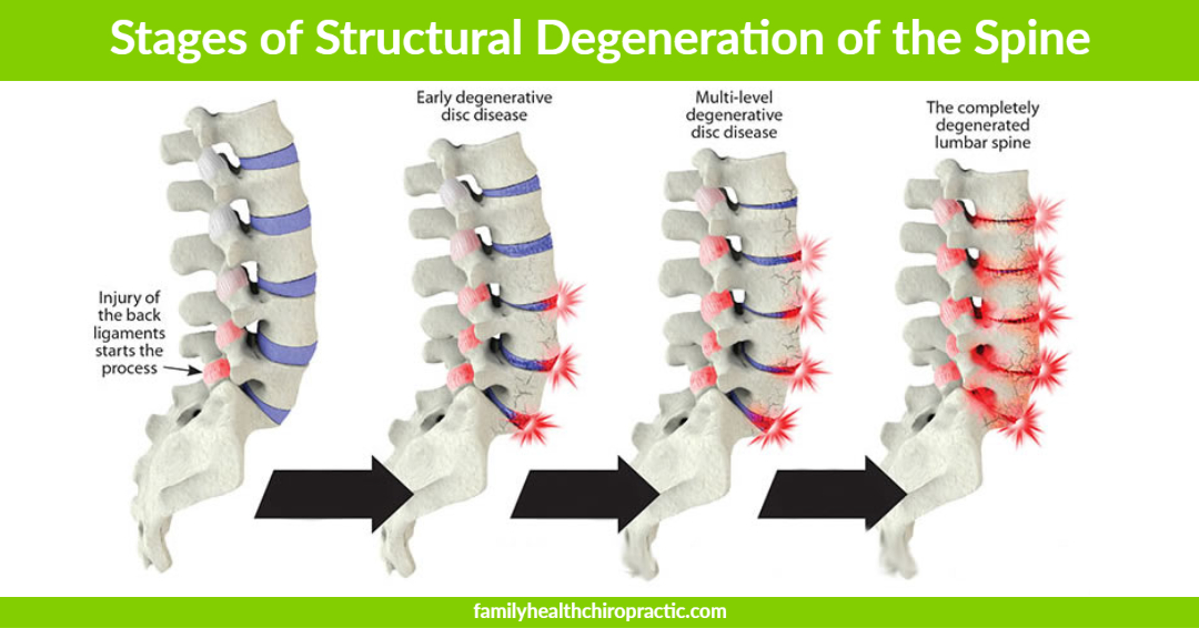 Stages of Structural Degeneration of the Spine
