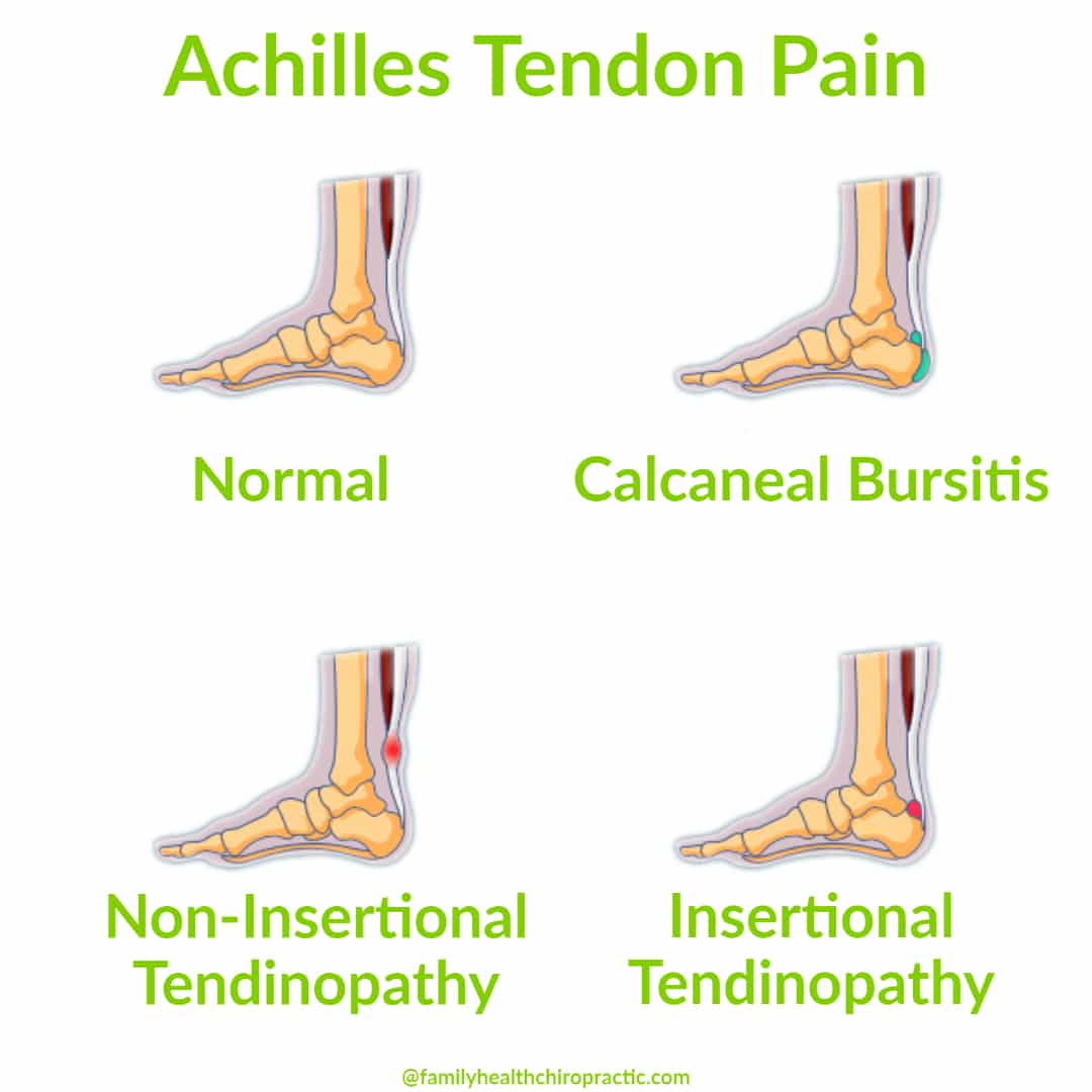 The 2 Common Types of Heel Spurs | Sports-health