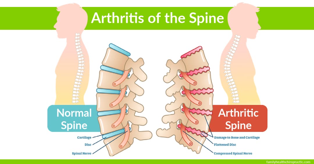 arthritis of the spine