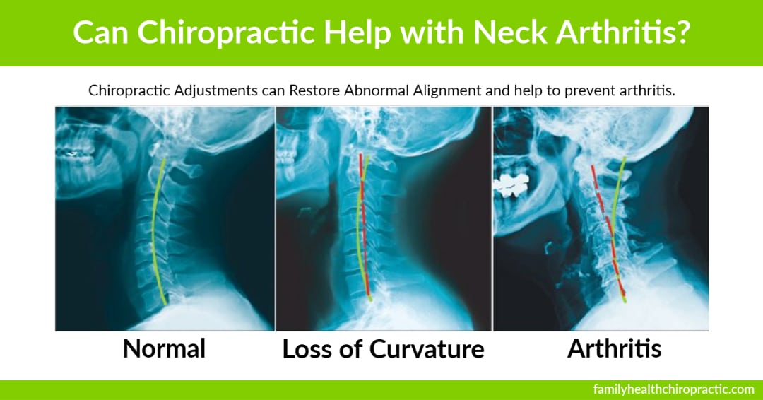 can chiropractic help with neck arthritis