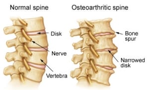 chiropractic care for arthritis