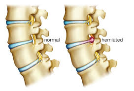 herniated-disc-austin-chiropractor