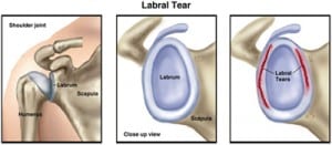 labral tear test