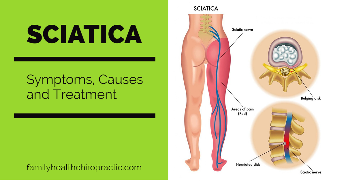 sciatica symptoms causes and treatment by austin chiropractor