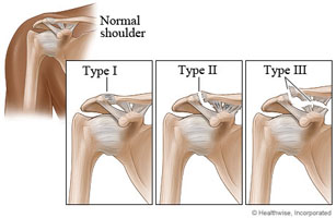 ac shoulder joint separation