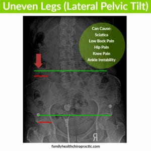 uneven legs causes back pain